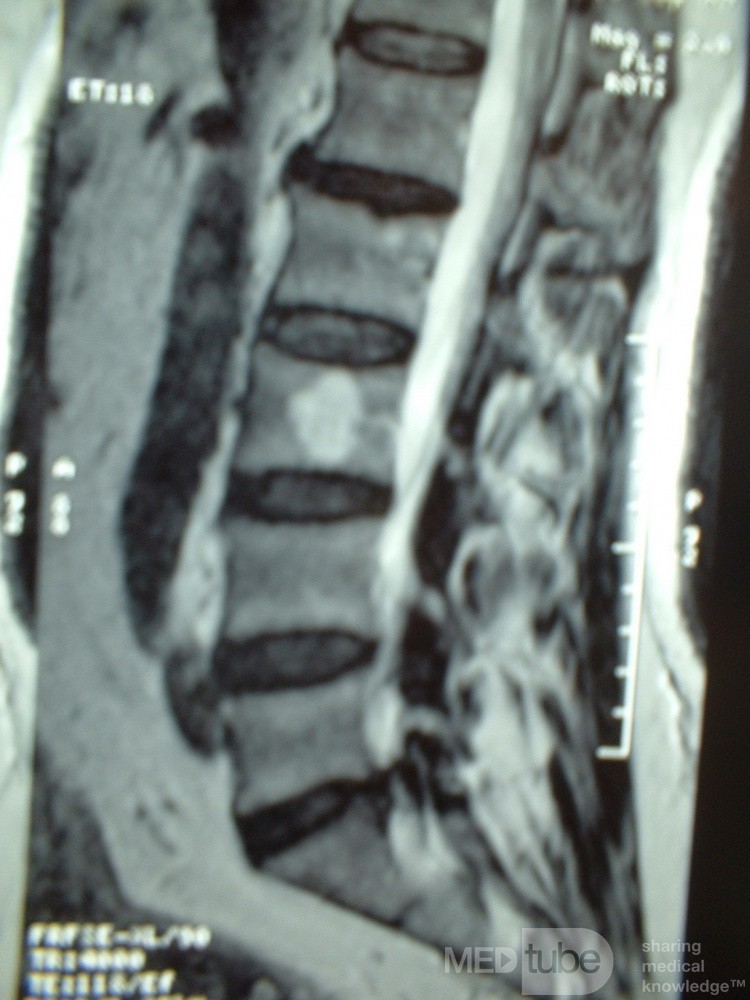 Hemangioma