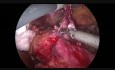 One Step Conversion Of A Failed Gastric Banding Into A Sleeve Gastrectomy
