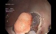 Small Lesion Rectal Untroubled ESD