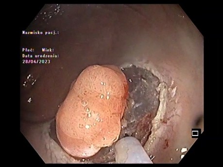 Small Lesion Rectal Untroubled ESD