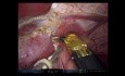 Robotic Left Hepatectomy and Partial Caudate Resection