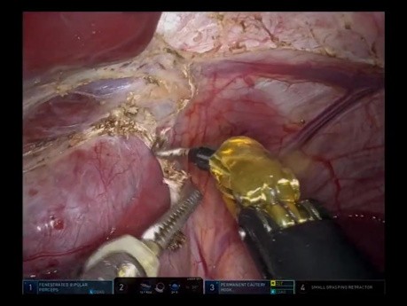 Robotic Left Hepatectomy and Partial Caudate Resection