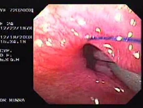 Flexible Endoscopic Suturing - Suctioning