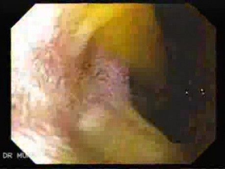 Choledocoduodenostomy (2 of 3)