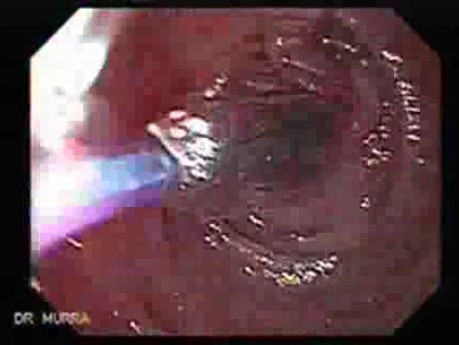 Gastric Cicatrization With Pylorus Stenosis (5 of 23)