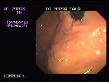 Gastroscopy with Retroflexed Maneuver