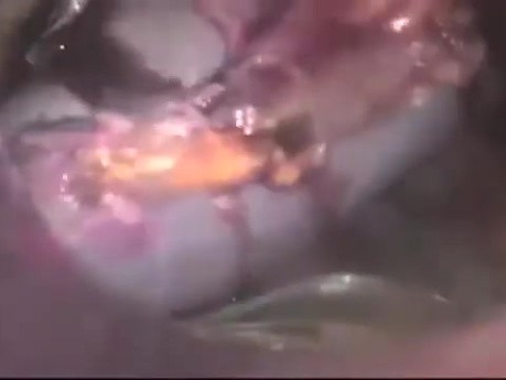 Pelvic and Abdominal Tumor Debulking