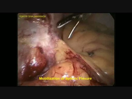 Colorectal - Laparoscopic Ultra Low Anterior Resection