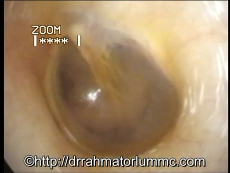 Otoendoscopy - Appearance of The Normal Eardrum