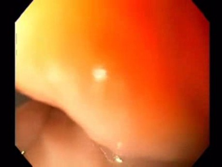 Endoscopic Balloon Removal (6 of 9)