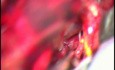Clipping of a Basilar Artery Aneurysm