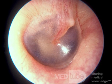 Normal Tympanic Membrane Light Reflex