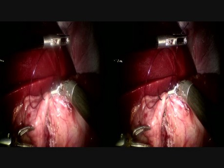 medVC - Live surgical session France-Finland 2016