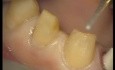 Upper Arch Teeth Preparation And Provisional Crowns (2/5)