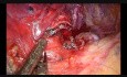 Non Edited Subxiphoid Uniportal Vats Right Upper Lobectomy
