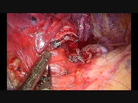 Non Edited Subxiphoid Uniportal Vats Right Upper Lobectomy