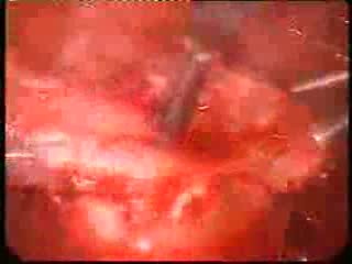 Cystic Uterine Myoma - Laparoscopic Treatment