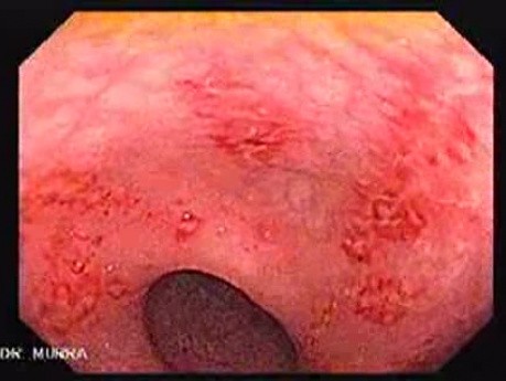 Endoscopic View Of Diverticulitis Of The Sigmoid (4 of 4)