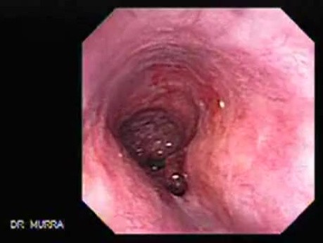 Barrett's Esophagus of long segment (17 of 24)
