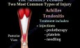 Achilles Tendon Rupture - Video Lecture