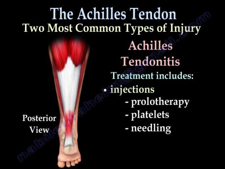 Achilles Tendon Rupture - Video Lecture