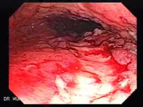 Multiple Rectal Ulcers (25 of 110)