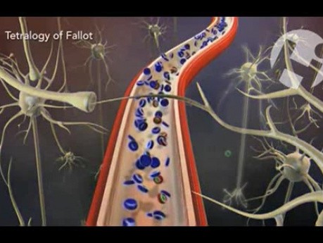 Damage from Tetralogy of Fallot Defects