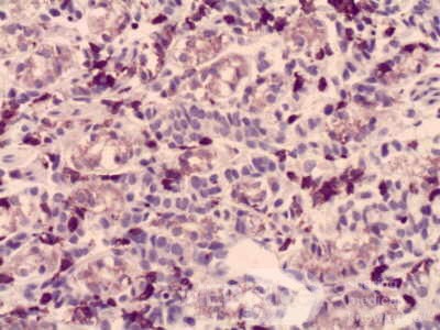 Gastric Cancer (12 of 15)