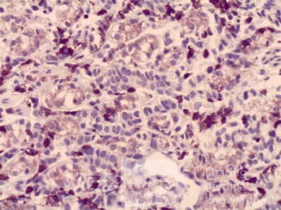 Gastric Cancer (12 of 15)