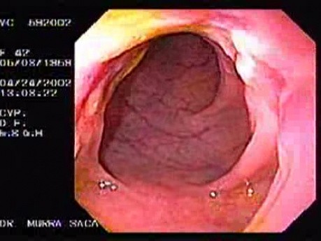 Crohn´s Disease (1 of 28)