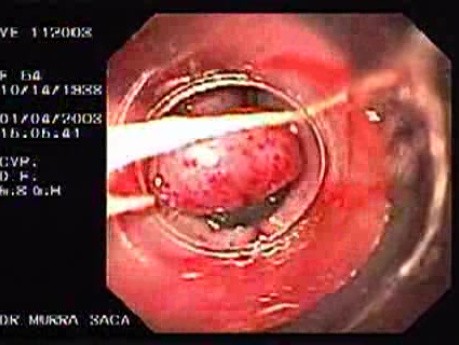 Banding of Esophageal Varices - Two Ligated Varices