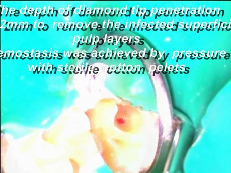 MTA - Partial Pulpotomy Nowadays