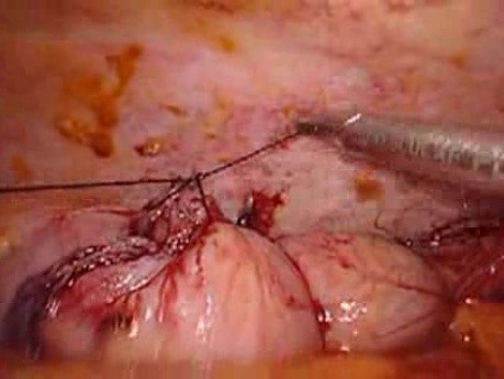 Colonic Perforation With Peritonitis - Laparoscopy (11 of 46)