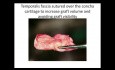 Grossly Depressed Nose - Technique for Correction with Concha Cartilage