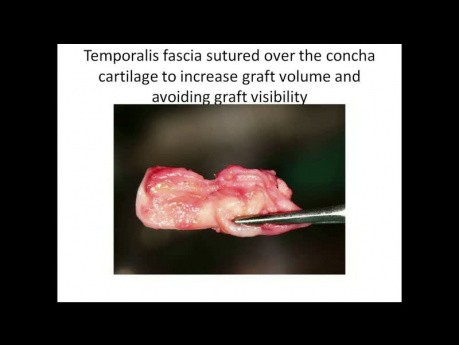 Grossly Depressed Nose - Technique for Correction with Concha Cartilage