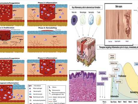 Chronic Wounds