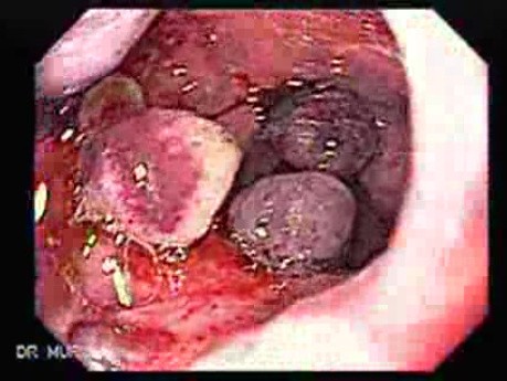 Long Standing Alcohol Abuse - Procedure of Esophageal Varix Ligation