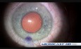 Anterior Ophthalmic Microsurgery Cataract