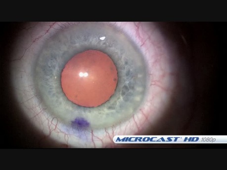 Anterior Ophthalmic Microsurgery Cataract