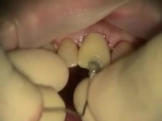 How To Deal With Apical Fenestration While Immediate Implantation