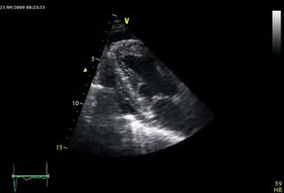 Chronic Pericarditis With Thickening Of The Pericardium