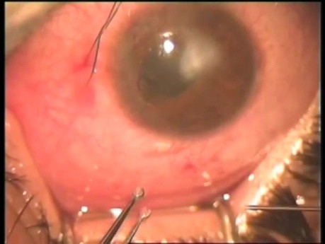 Fugo Plasma Blade Vs Femtosecond Laser as Technologies of Filtration Surgery