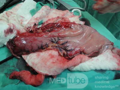 Gastric Ulcerated Adenocarcinoma of the Pre-pyloric Antrum (21 of 28)