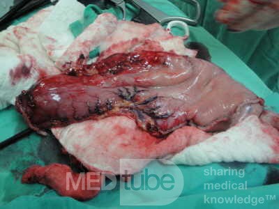 Gastric Ulcerated Adenocarcinoma of the Pre-pyloric Antrum (21 of 28)