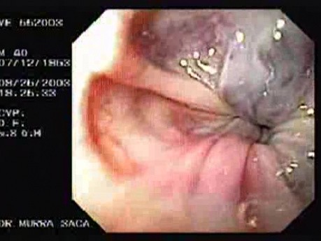 Acute Variceal Bleeding - Large Varices with Red Sign