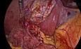 Retrograde Cholecystectomy