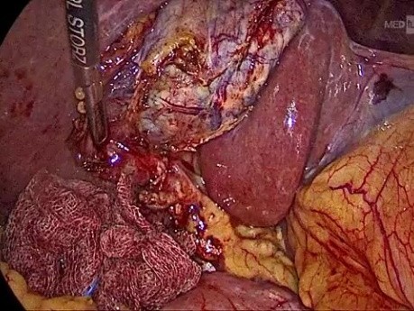 Retrograde Cholecystectomy