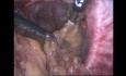 Parastomal Hernia Repair. Laparoscopic Sugarbaker Approach.