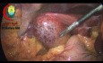 Acute Cholecystitis To Be Done Early Within The First 3 Days
