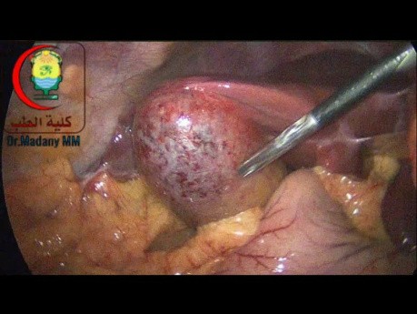 Acute Cholecystitis To Be Done Early Within The First 3 Days